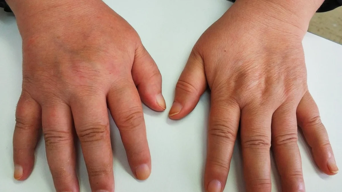 Síndrome de Südeck Qué es y cómo se trata Clinica fisioterapia Jaen Pablo carvajal fisio fisioterapeuta